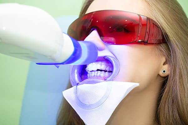 Laser teeth whitening treatments Midlands