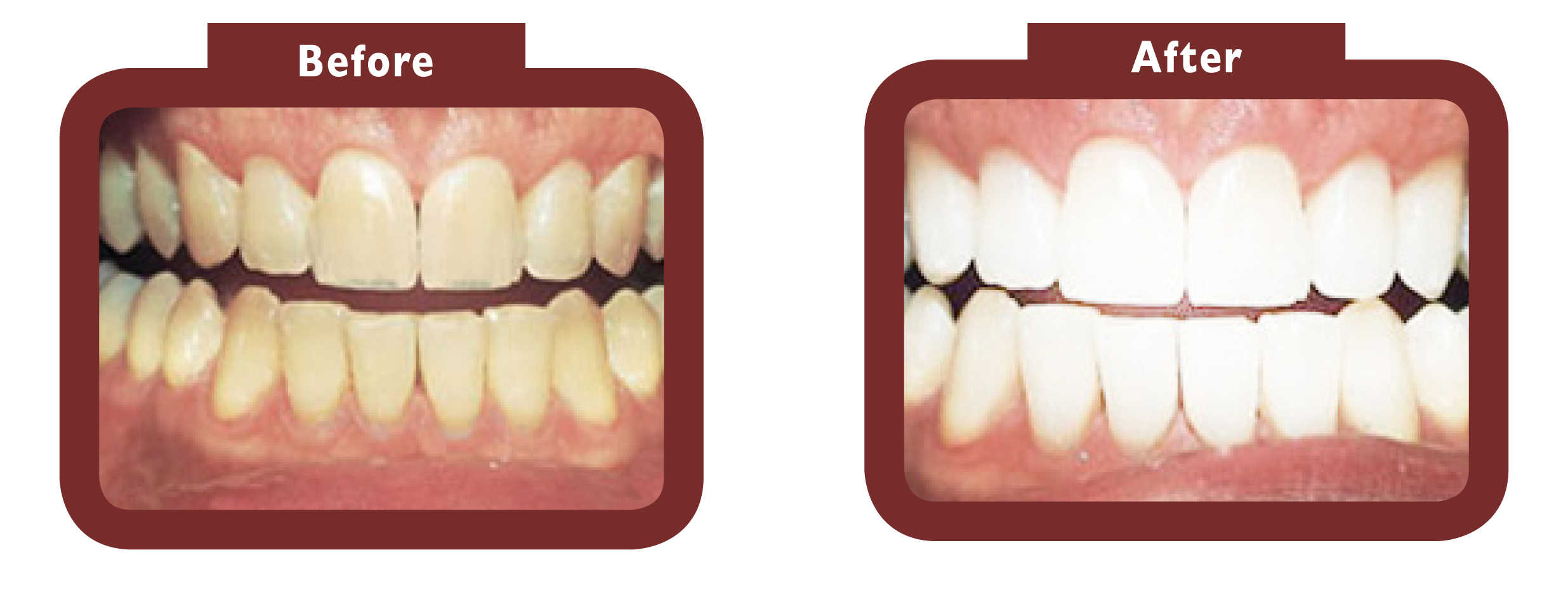 before and after teeth whitening - LA TEETH Midlands