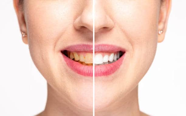 Teeth Whitening Milton Keynes Midlands