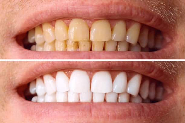 Laser White For Ever Bright – Get a Brighter, Whiter Smile with LA Teeth Whitening Midlands