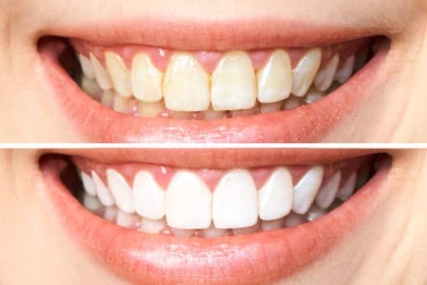 Achieve a Dazzling Smile for Your Special Day: A Guide to Wedding Teeth Whitening Midlands