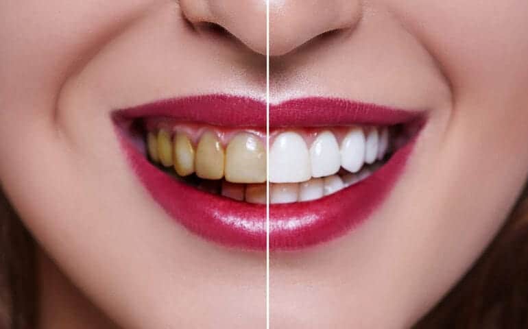 Teeth Whitening Ascot Windsor Midlands