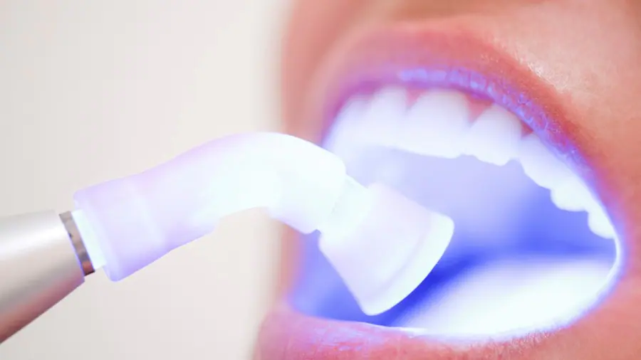 Teeth Whitening Aylesbury Midlands